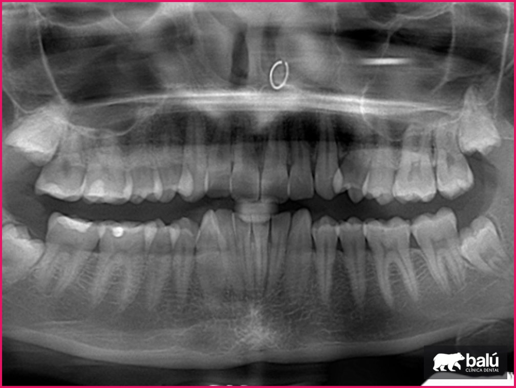 Radiografía dental: para qué sirve y con qué frecuencia se hace