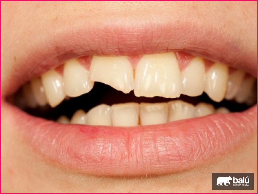 Reconstrucción dental: en qué consiste y cuándo se necesita