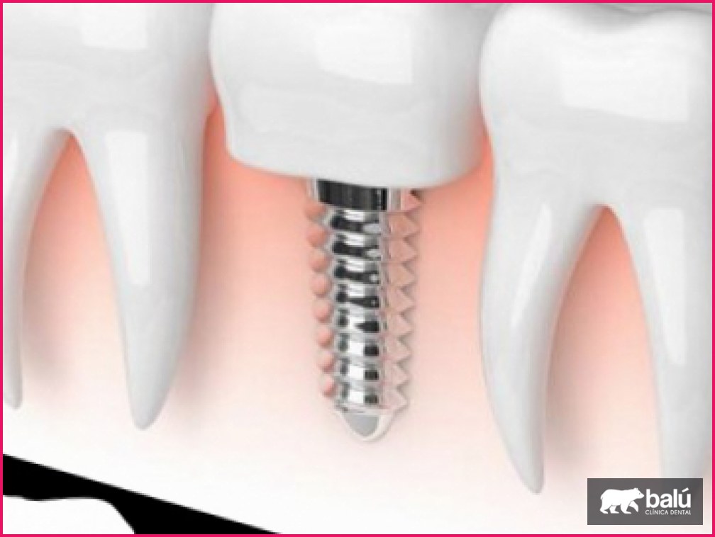 Mini implantes dentales: qué son y para quién son una opción