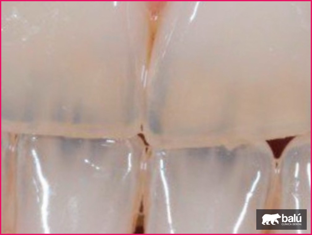 El color natural de los dientes: por qué varía y cuándo cambiar