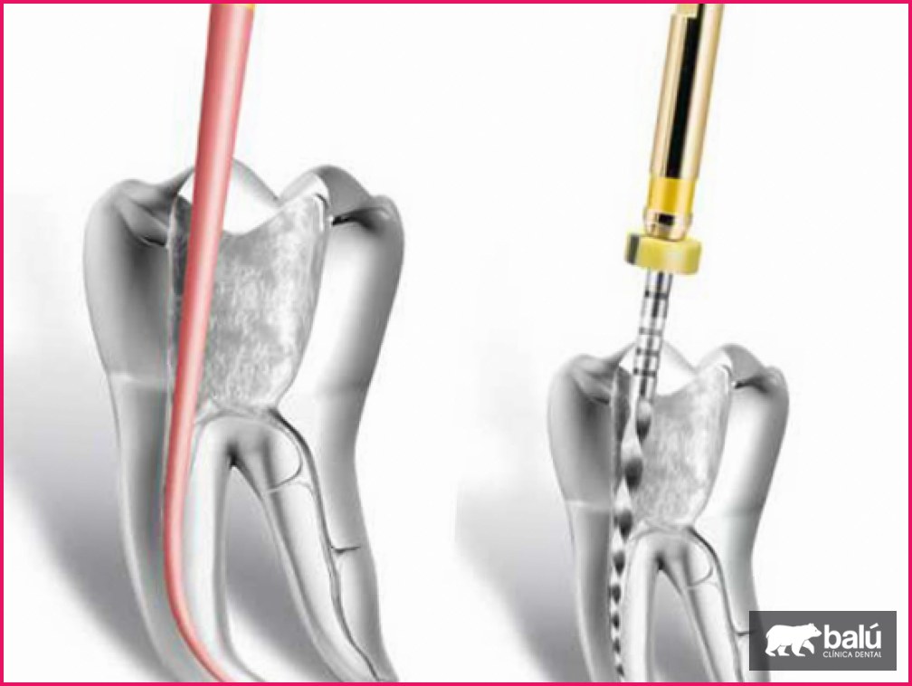 Endodoncia rotatoria: en qué consiste esta técnica