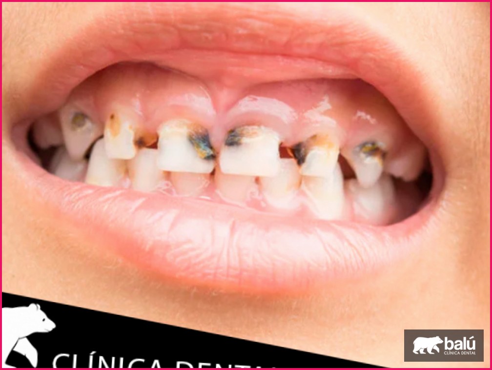 Caries en dientes de leche: por qué pasan y cómo tratarlas
