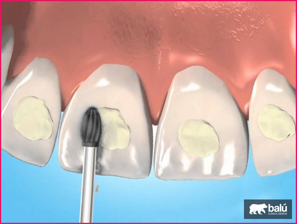 Adhesión dental (bonding): qué es y para qué se usa