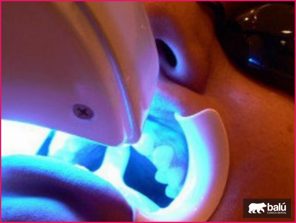 Blanqueamiento dental con láser: en qué consiste