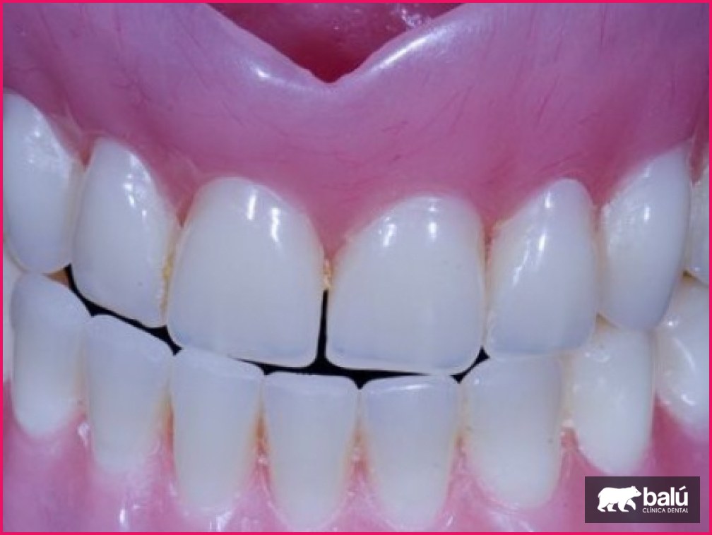 Tipos de dentaduras postizas que existen