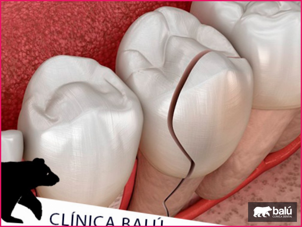 Muela rota: causas, síntomas y cuándo acudir al dentista