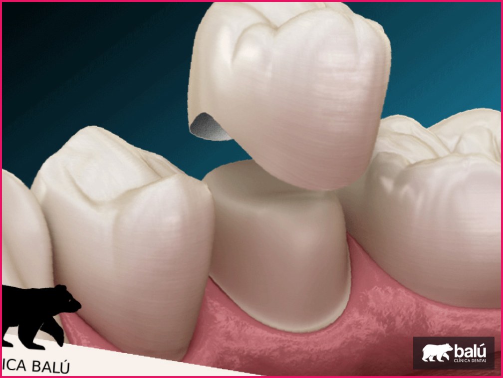 Coronas de zirconio: qué son y sus ventajas