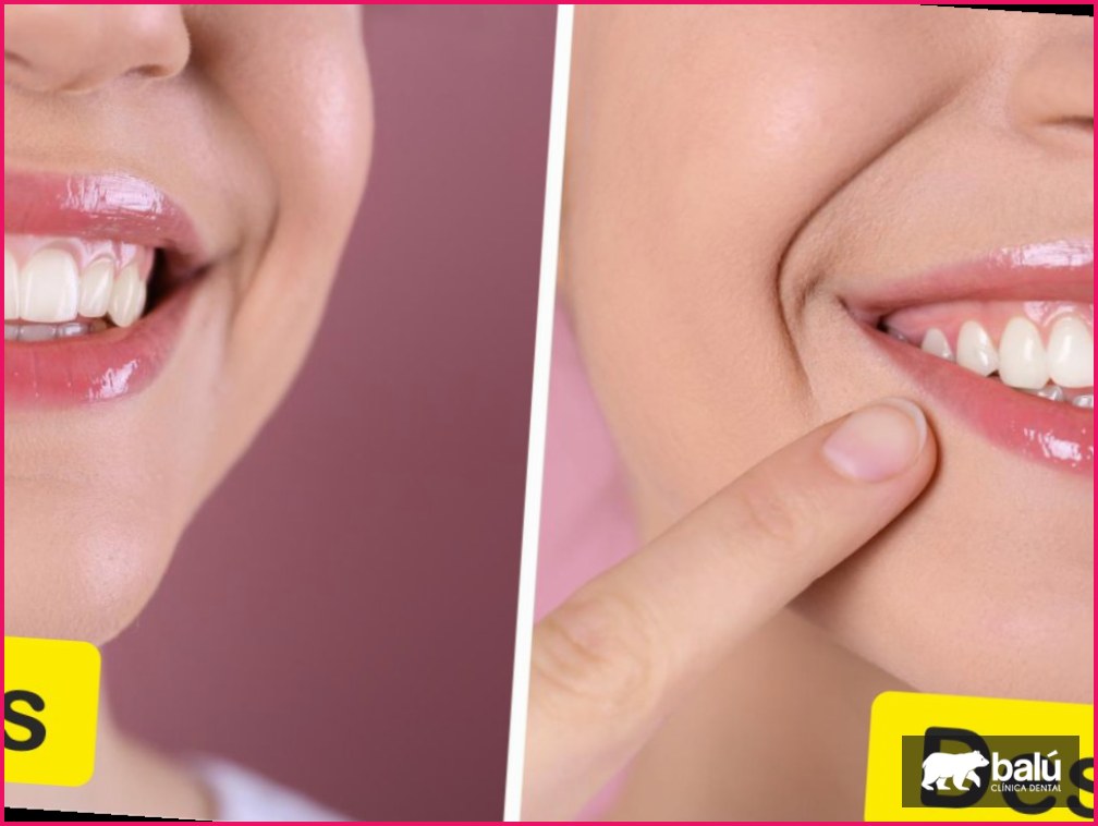 Sonrisa gingival: opciones para corregirla sin cirugía